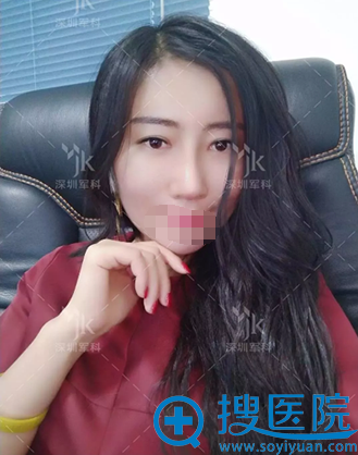 深圳军科刘月更假体隆鼻术后1个月效果 深圳军科刘月更假体隆鼻术后1个月效果