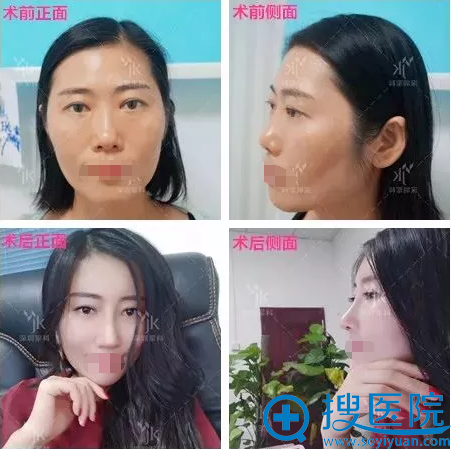 深圳军科刘月更假体隆鼻术前术后对比 深圳军科刘月更假体隆鼻术前术后对比