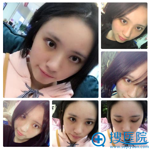 南京施尔美陈超双眼皮7天拆线效果 南京施尔美陈超双眼皮7天拆线效果