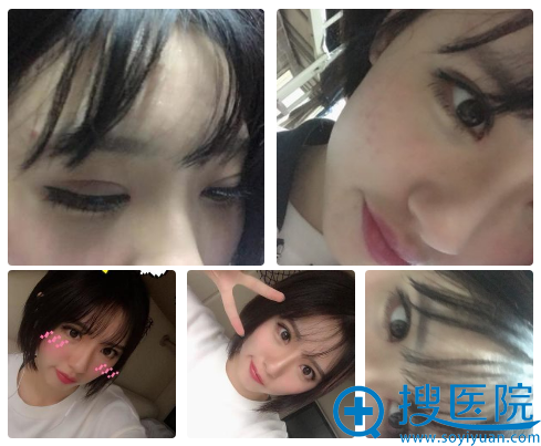 去南京施尔美割双眼皮18天恢复情况 去南京施尔美割双眼皮18天恢复情况