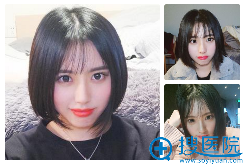 南京施尔美陈超双眼皮案例3个月自拍 南京施尔美陈超双眼皮案例3个月自拍