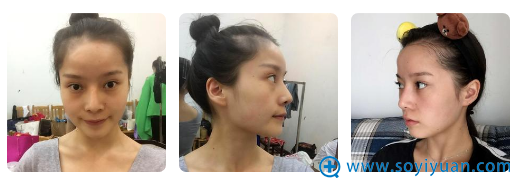 重庆脂肪填充哪家医院好?看重庆华美李富强做的填充案例怎么样