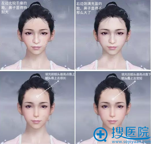 西安艺星全脸脂肪填充对比照揭秘怎样通过自体脂肪填充变萌妹子