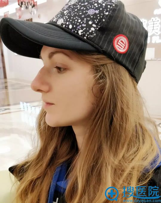 Asya做手术前的驼峰鼻侧面照 Asya做手术前的驼峰鼻侧面照
