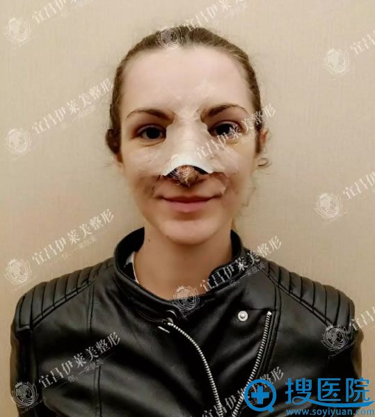 宜昌伊莱美王文俊鼻综合案例5天效果 宜昌伊莱美王文俊鼻综合案例5天效果