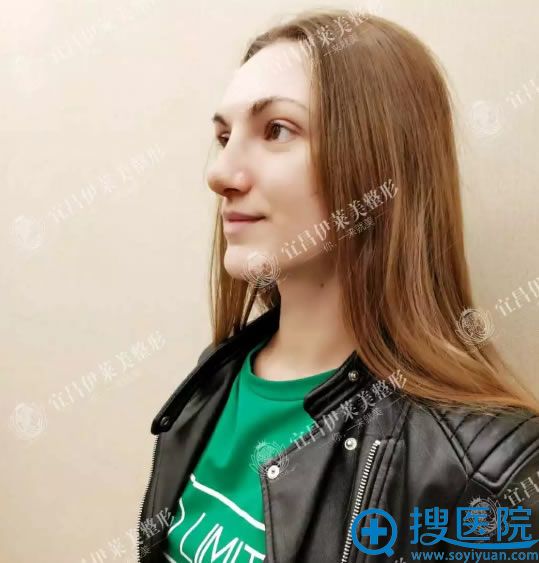 驼峰鼻矫正术后一周恢复照 驼峰鼻矫正术后一周恢复照