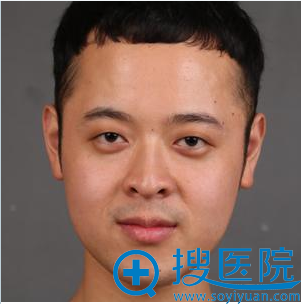 双眼皮术前照片 双眼皮术前照片