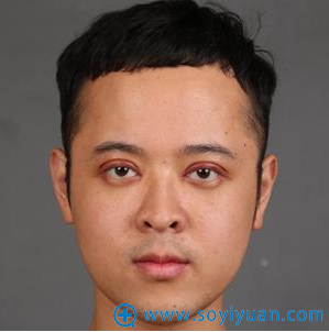 双眼皮3天后自拍 双眼皮3天后自拍