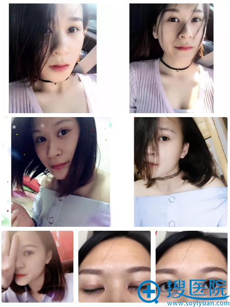 找贵阳华美韩胜斌做完双眼皮2个月了 找贵阳华美韩胜斌做完双眼皮2个月了