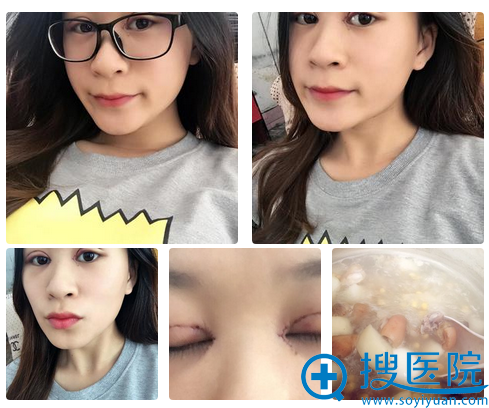 做完双眼皮第二天拆纱布 做完双眼皮第二天拆纱布