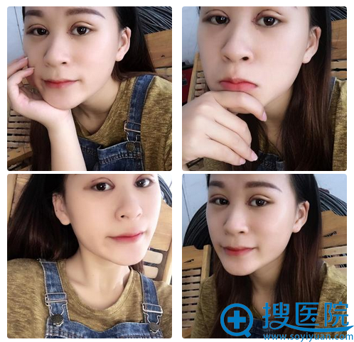双眼皮第3天恢复情况 双眼皮第3天恢复情况