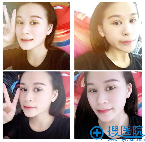 双眼皮第6天效果图 双眼皮第6天效果图