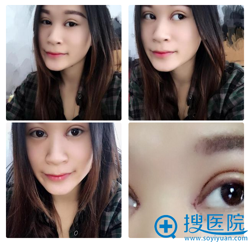 做完双眼皮7天拆完线的样子 做完双眼皮7天拆完线的样子