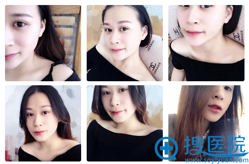 双眼皮术后一个月生活照 双眼皮术后一个月生活照