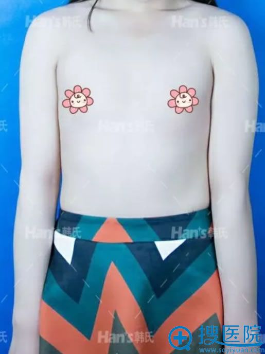 隆胸前的男儿胸膛模样 隆胸前的男儿胸膛模样