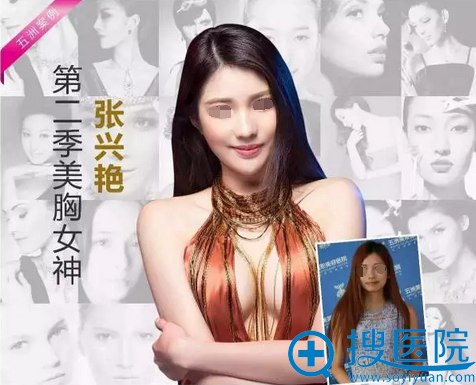 武汉五洲刘杨假体丰胸术前术后对比 武汉五洲刘杨假体丰胸术前术后对比