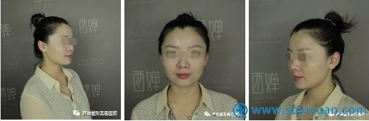 四川成都西婵廖茄利玻尿酸填充面部+面部综合提升跟大饼脸再见