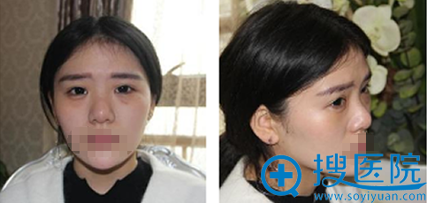 西安施尔绮苏鹏隆鼻案例:假体隆鼻+鼻头缩小术后半年效果展示