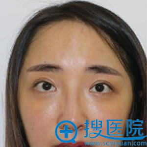 开外眼角和眼睑下至术术前照片 开外眼角和眼睑下至术术前照片