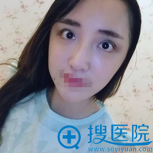 周鹏起开外眼角和眼睑下至术后一个月效果 周鹏起开外眼角和眼睑下至术后一个月效果