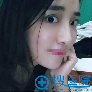 成都美未央开外眼角和眼睑下至术术后45天 成都美未央开外眼角和眼睑下至术术后45天