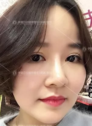 双眼皮修复怎么做的 常德伊丽莎白朱立德埋线双眼皮修复过程