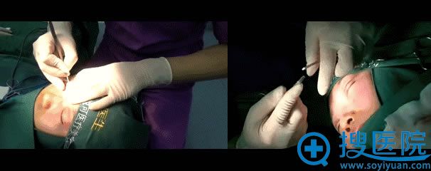 双眼皮手术的缝合过程 双眼皮手术的缝合过程