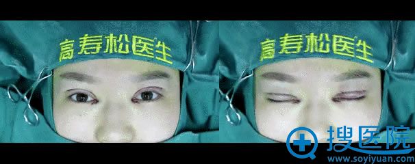 <!--<i data=20240710 data-id=16683></i>-->割双眼皮术后即刻效果 <!--<i data=20240710 data-id=16683></i>-->割双眼皮术后即刻效果