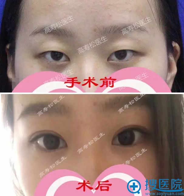 <!--<i data=20240710 data-id=16683></i>-->显微动态双眼皮术前术后效果对比 <!--<i data=20240710 data-id=16683></i>-->显微动态双眼皮术前术后效果对比