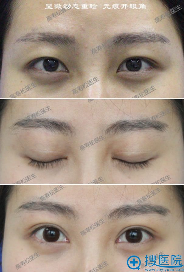 显微动态双眼皮和开眼角半年恢复照 显微动态双眼皮和开眼角半年恢复照