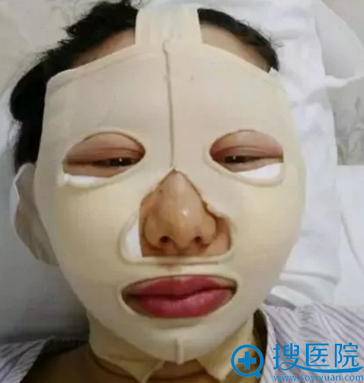 见过的磨骨手术术后照片 见过的磨骨手术术后照片