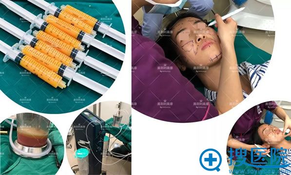 自体脂肪填充全脸手术过程图 自体脂肪填充全脸手术过程图