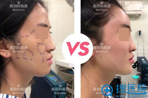 自体脂肪填充解决颧骨突出问题 自体脂肪填充解决颧骨突出问题
