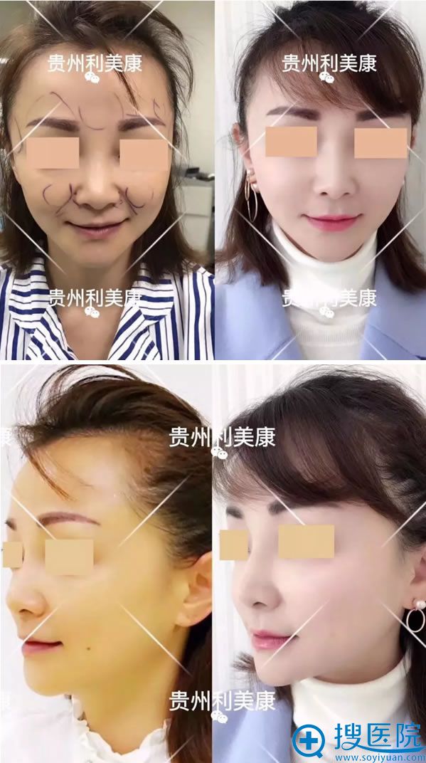 自体脂肪填充全脸会让脸变大吗 自体脂肪填充全脸会让脸变大吗