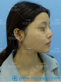 深圳铭医肋软骨全鼻整形+自体脂肪填充全脸整体打造重塑美丽