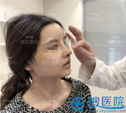 肋软骨全鼻整形+自体脂肪填充全脸拆线效果 肋软骨全鼻整形+自体脂肪填充全脸拆线效果