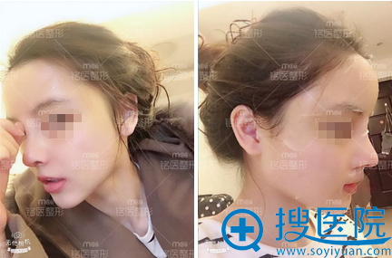 肋软骨隆鼻+面部脂肪填充术后恢复情况 肋软骨隆鼻+面部脂肪填充术后恢复情况