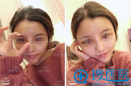深圳铭医肋软骨隆鼻+脂肪填充面部术后生活照 深圳铭医肋软骨隆鼻+脂肪填充面部术后生活照