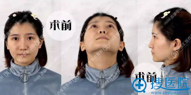 做鼻综合手术前的照片 做鼻综合手术前的照片