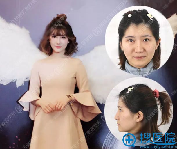 大连明医汇<!--<i data=20240710 data-id=16852></i>-->鼻综合2个月效果对比图 大连明医汇<!--<i data=20240710 data-id=16852></i>-->鼻综合2个月效果对比图