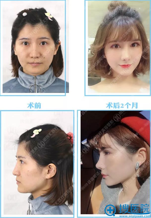 大连明医汇<!--<i data=20240710 data-id=16852></i>-->肋软骨鼻综合案例 大连明医汇<!--<i data=20240710 data-id=16852></i>-->肋软骨鼻综合案例