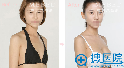 常州美贝尔整形美容医院假体隆胸对比照 常州美贝尔整形美容医院假体隆胸对比照