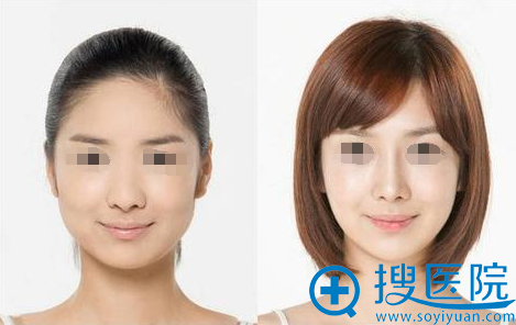常州美贝尔整形美容医院瘦脸案例 常州美贝尔整形美容医院瘦脸案例