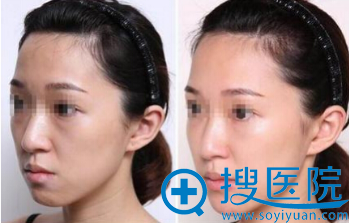 常州美贝尔自体脂肪填充面部案例 常州美贝尔自体脂肪填充面部案例