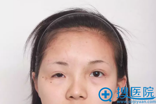 瘢痕切除和眼提肌手术术后效果 瘢痕切除和眼提肌手术术后效果