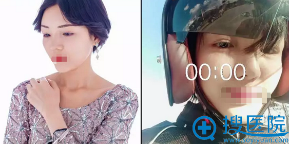 第三次修复手术术后写真及生活照 第三次修复手术术后写真及生活照