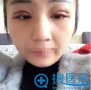 长沙美莱整形切开双眼皮术后即刻效果 长沙美莱整形切开双眼皮术后即刻效果