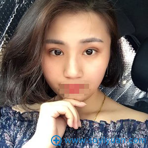 黄威切开双眼皮一个月恢复照 黄威切开双眼皮一个月恢复照