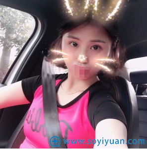 长沙美莱双眼皮术后四个月效果 长沙美莱双眼皮术后四个月效果