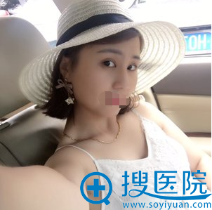 长沙美莱黄威双眼皮术后半年照片 长沙美莱黄威双眼皮术后半年照片